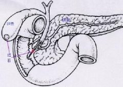 直腸炎不及時治療會有什么并發癥